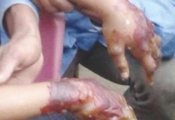 Una madre quemó ambas manos a hijo de seis años con una estufa en La Vega