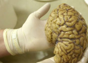 Un misterioso trastorno cerebral desconcierta a los médicos canadienses