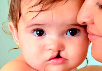 Robert Reid Cabral inicia Jornada Quirúrgica de Labio y Paladar Hendido