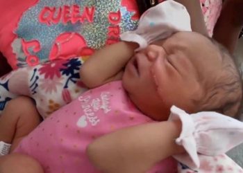 Recién nacido recibe 13 puntos de sutura tras sufrir corte en el rostro durante cesárea