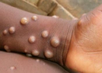 Descartan viruela del mono este en el país