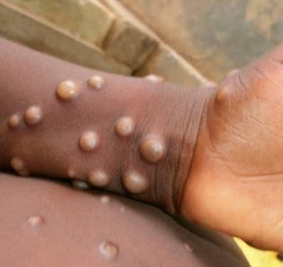 Descartan viruela del mono este en el país