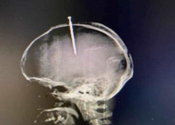 Muere hombre se había intruducido clavo en la cabeza porque »sentía el cerebro flojo»