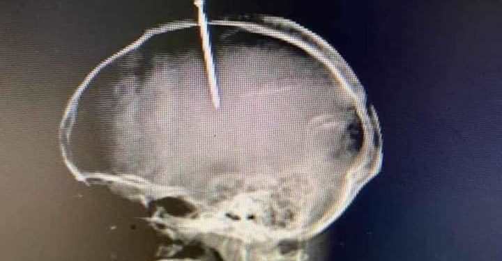 Muere hombre se había intruducido clavo en la cabeza porque »sentía el cerebro flojo»