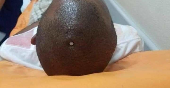 ¡Insolito! Hombre se clava la cabeza por sentirse el cerebro flojo