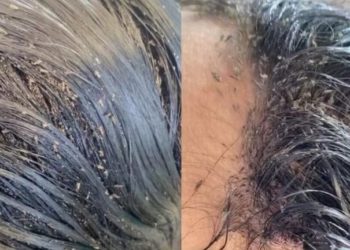 El vídeo viral de una niña totalmente plagada de piojos: tenía más de 15.000 insectos en su cabeza