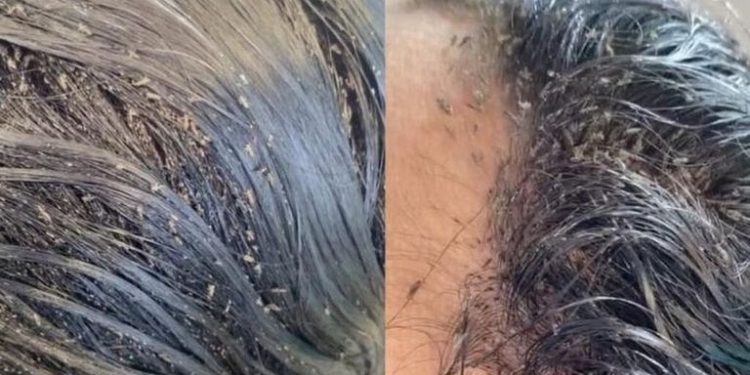 El vídeo viral de una niña totalmente plagada de piojos: tenía más de 15.000 insectos en su cabeza