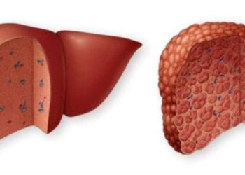 Estudio: pacientes con cirrosis por alcohol tienen peores pronósticos de recuperación de una enfermedad grave