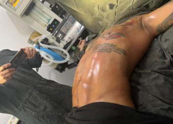 El Mayor Clásico dice que pocos urbanos admiten sus retoques tras someterse a una cirugía estética