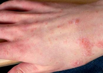 Salud Pública afirma enfermedad cutánea afecta Haití no está presente en RD