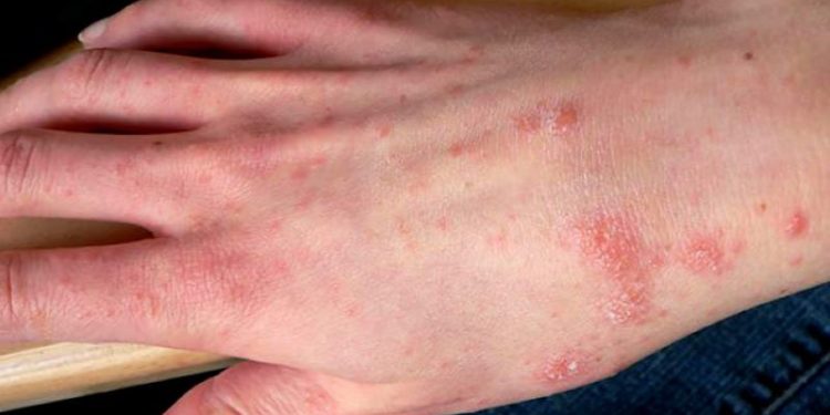 Salud Pública afirma enfermedad cutánea afecta Haití no está presente en RD