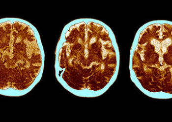 El cerebro de los supervivientes de una forma grave de covid-19 envejece 20 años, dice un nuevo estudio