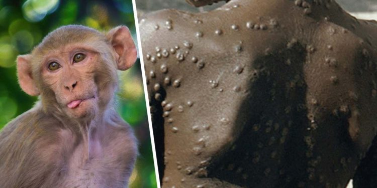 Antivirales podrían reducir la duración de los síntomas de viruela del mono