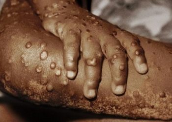 OMS convoca la comisión de emergencias ante la expansión de viruela del mono