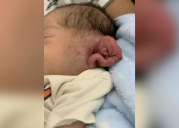 Cortan parte de la oreja de un bebé durante una cesárea iluminada con un móvil