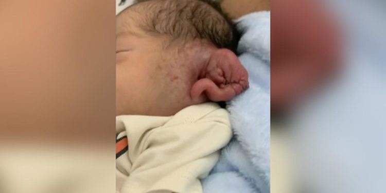 Cortan parte de la oreja de un bebé durante una cesárea iluminada con un móvil