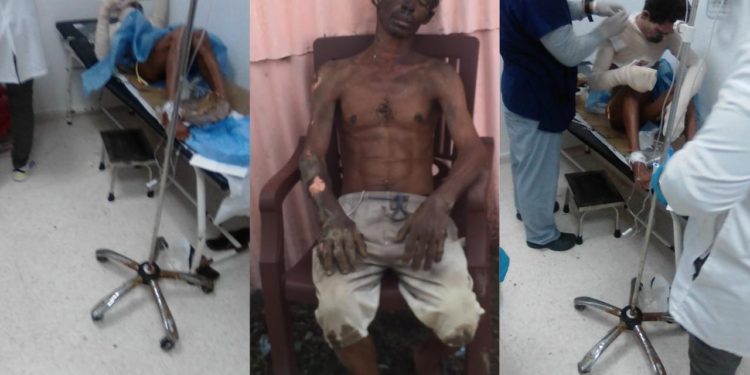 Mujer resulta afectada tras lanzar agua hirviendo a esposo por supuestos asuntos pasionales