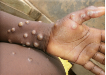 Paciente notificado con viruela del mono sigue en recuperación; le darán de alta el fin de semana