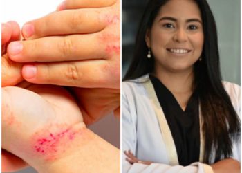 Francia Rosa Rodríguez: La Dermatitis Atópica es una enfermedad inflamatoria crónica de la piel